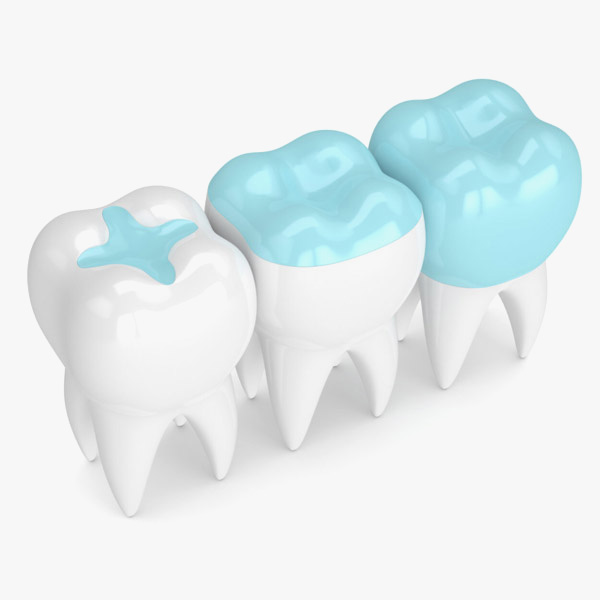 3D rendering of a composite filling