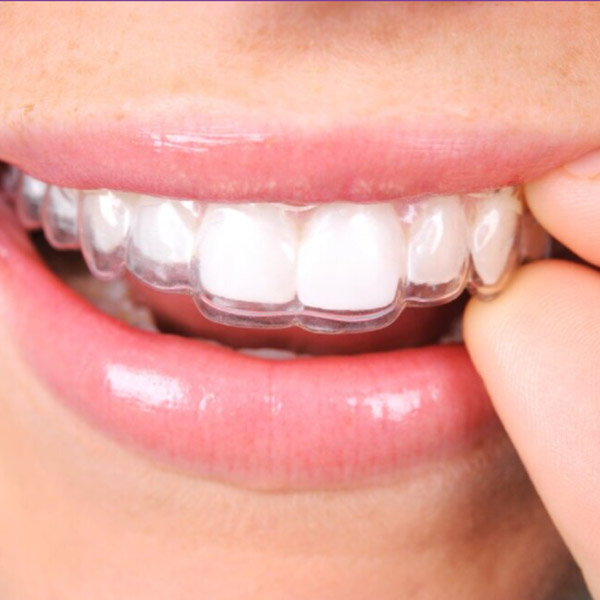 closeup of woman adjusting clear aligners
